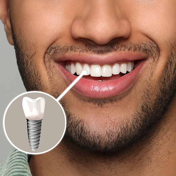 The image shows a smiling man with a visible tooth gap, highlighting a dental implant screwed into his upper jaw, labeled with an arrow pointing to the implant.