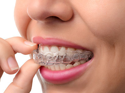 The image shows a close-up of a person s face with their teeth covered by a clear dental alignment device, known as an orthodontic appliance, while they are holding the device in their hand and looking at it intently.