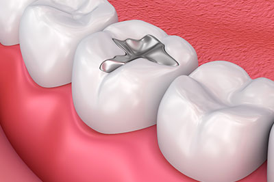 The image displays a close-up view of a dental implant inserted into a tooth gap within a mouth with visible teeth, gums, and tongue.