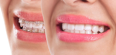 The image shows a close-up of a woman s face with her mouth open, revealing teeth and lips, against a blurred background that appears to be a portrait orientation photo.