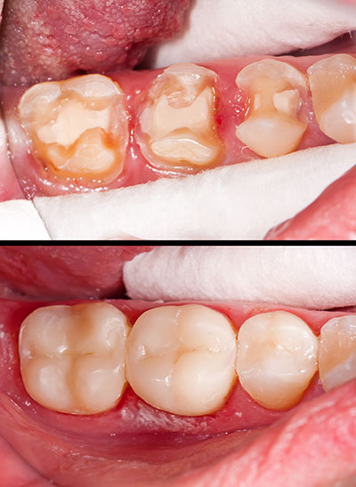 The image displays two photographs side by side  on the left, there s a close-up view of an open mouth with visible tooth decay, plaque buildup, and possible gum disease  on the right, the same mouth appears after dental treatment, showing clean teeth and healthy gums.