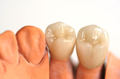 The image shows a set of three teeth models placed side by side against a white background, with two on the left appearing to be natural human teeth and one on the right that has been altered to have a gap between them.