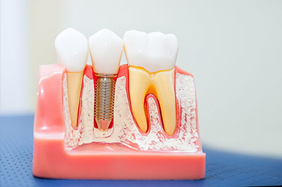 The image shows a model of a human mouth with teeth and gums, featuring a dental implant and a bridge, against a blue background.