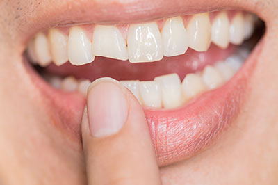 The image shows a close-up of a person s mouth with teeth, holding a finger between their teeth, smiling broadly.