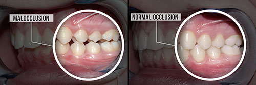 The image shows a side-by-side comparison of a mouth with teeth before and after a dental procedure, highlighting the transformation from natural teeth to artificial ones, labeled with  malocclusion  and  normal occlusion.