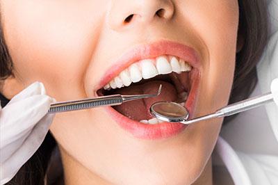 A woman with a wide smile is holding her mouth open while a dental hygienist works on her teeth, using a mirror to examine her oral cavity.