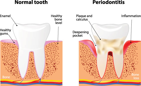 The image shows a diagrammatic representation of the stages of tooth decay progressing from normal to periodontitis, illustrating the effects on teeth and gums with annotations indicating healthy bone, inflammation, and bone loss.