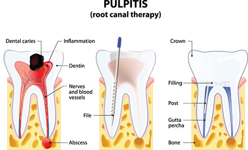 The image depicts a medical illustration showing a cross-section view of a tooth with pulpititis, highlighting inflammation around the pulp chamber, a dentin bridge, and a filling post.