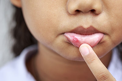 Girl with acne on her face, holding her finger up to her lips.