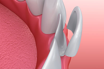 The image shows a close-up view of a dental implant with a metal screw visible on the surface of the gum, set against a pink background that resembles a mouth or tongue.