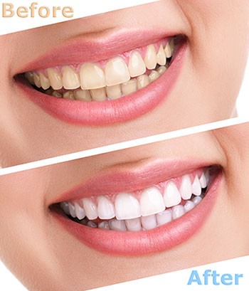 The image shows a before-and-after comparison of teeth whitening, with two photos of a person s smiling mouth, one showing natural teeth and the other showing brightened teeth after the treatment, with text indicating the transformation process.