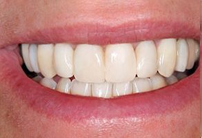 The image shows a close-up view of a person s smiling mouth with white teeth, wearing lipstick, against a neutral background.