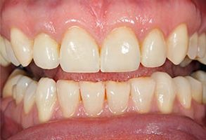 The image displays a close-up view of a person s teeth with yellowish stains, showcasing a smile with an open mouth revealing some discoloration on the front teeth.