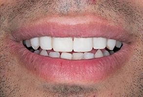 The image displays a close-up of a person s facial features with a focus on their mouth and teeth, showcasing a smile with white teeth and pink gums.