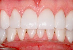 The image shows a close-up view of a person s teeth with an emphasis on dental hygiene, likely used for educational purposes to demonstrate proper oral care.