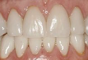 The image shows a close-up view of a person s teeth with a focus on a yellowing or stained area near the gum line, which might suggest dental issues such as tooth decay or discoloration.