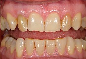 The image displays a close-up view of a person s teeth with a focus on dental work, featuring yellowed teeth and a pink gumline.