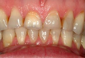 The image shows a close-up view of a person s teeth with yellowing, indicating possible dental issues such as discoloration or decay.
